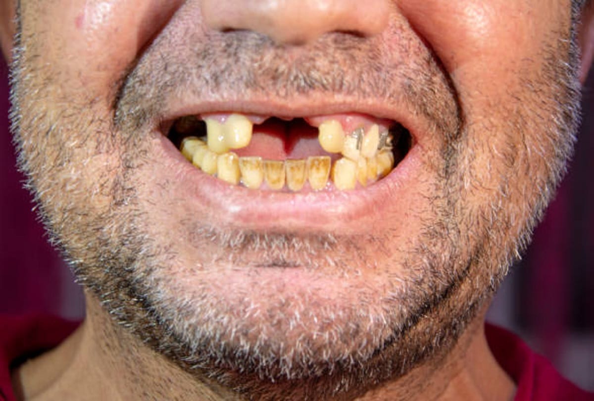 Dream Interpretation Tooth Break in Dream Astrology Know What Signifies All Details in Hindi