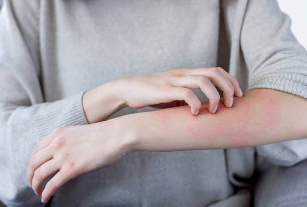 nairobi fly infection in india update, acid fly attack symptoms and prevention