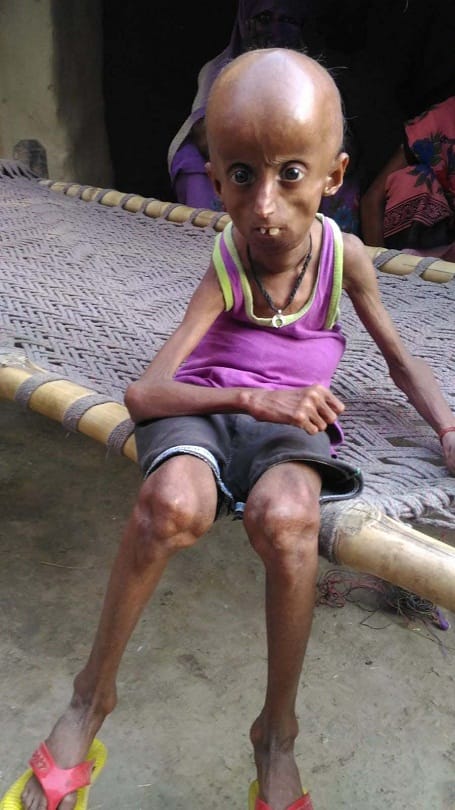 Death of a patient of Progeria found in Hanumanganj, looked 10 years old at the age of 25