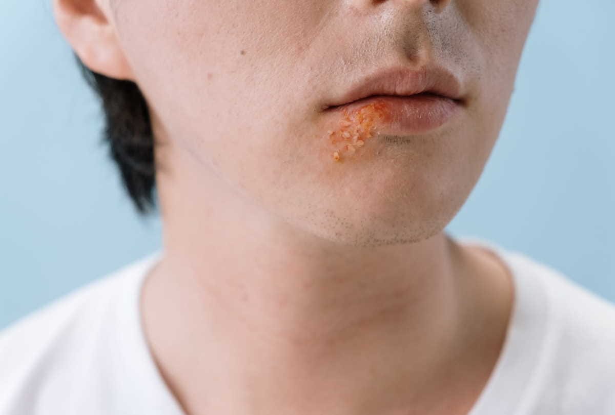 herpes simplex virus seen in Covid-19 patients
