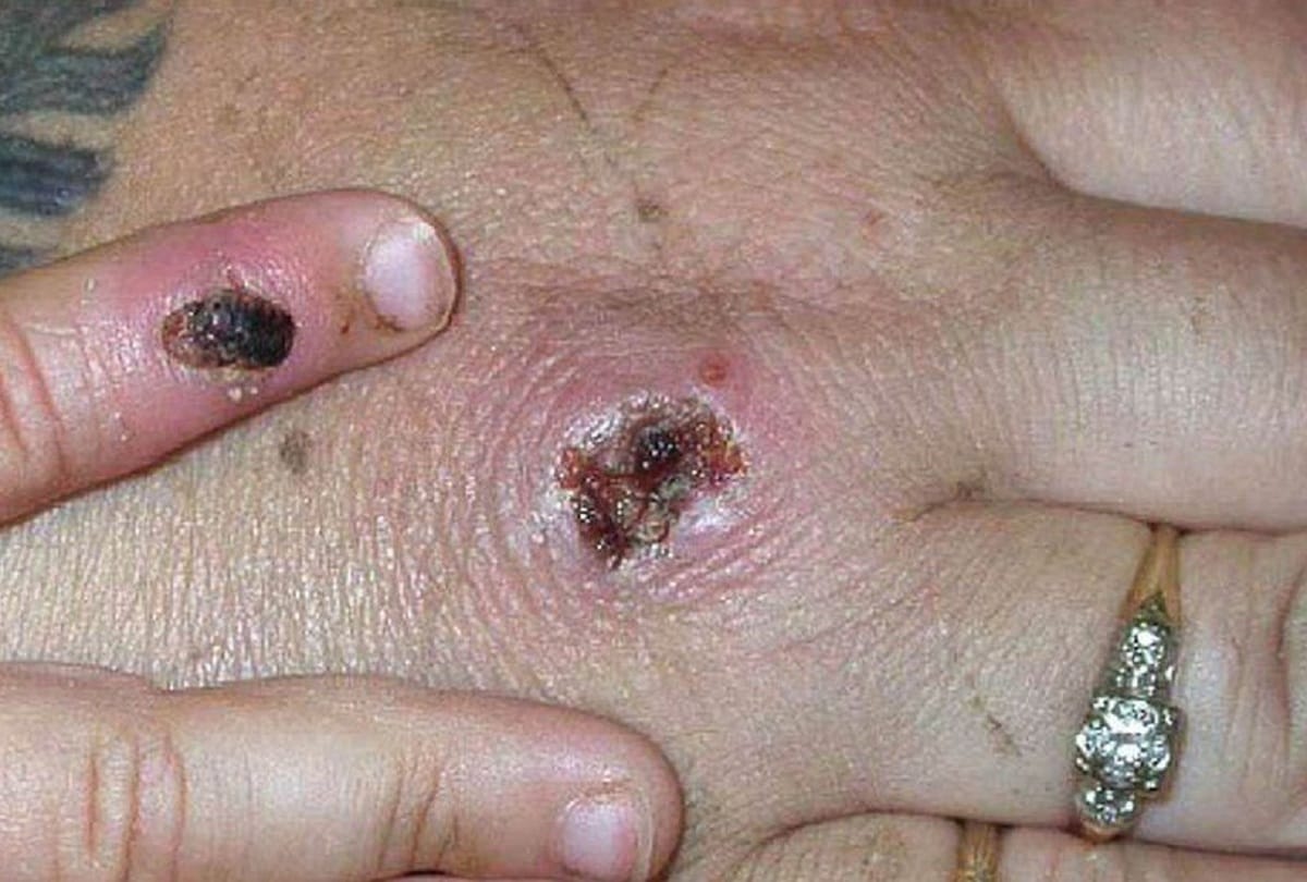 Monkeypox virus found in two people in wales