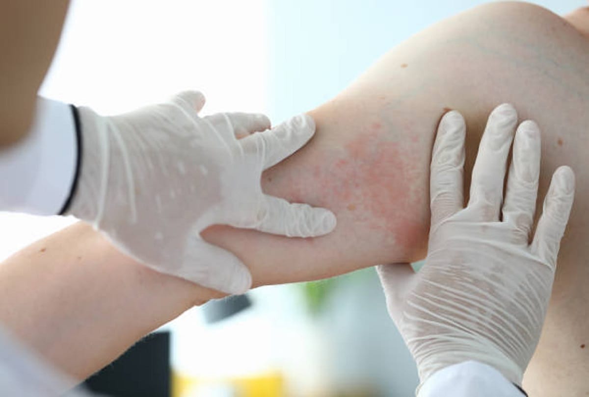 Skin disease Psoriasis Symptoms and causes in hindi