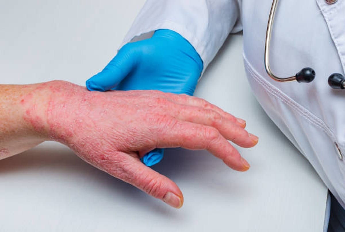 Skin disease Psoriasis Symptoms and causes in hindi