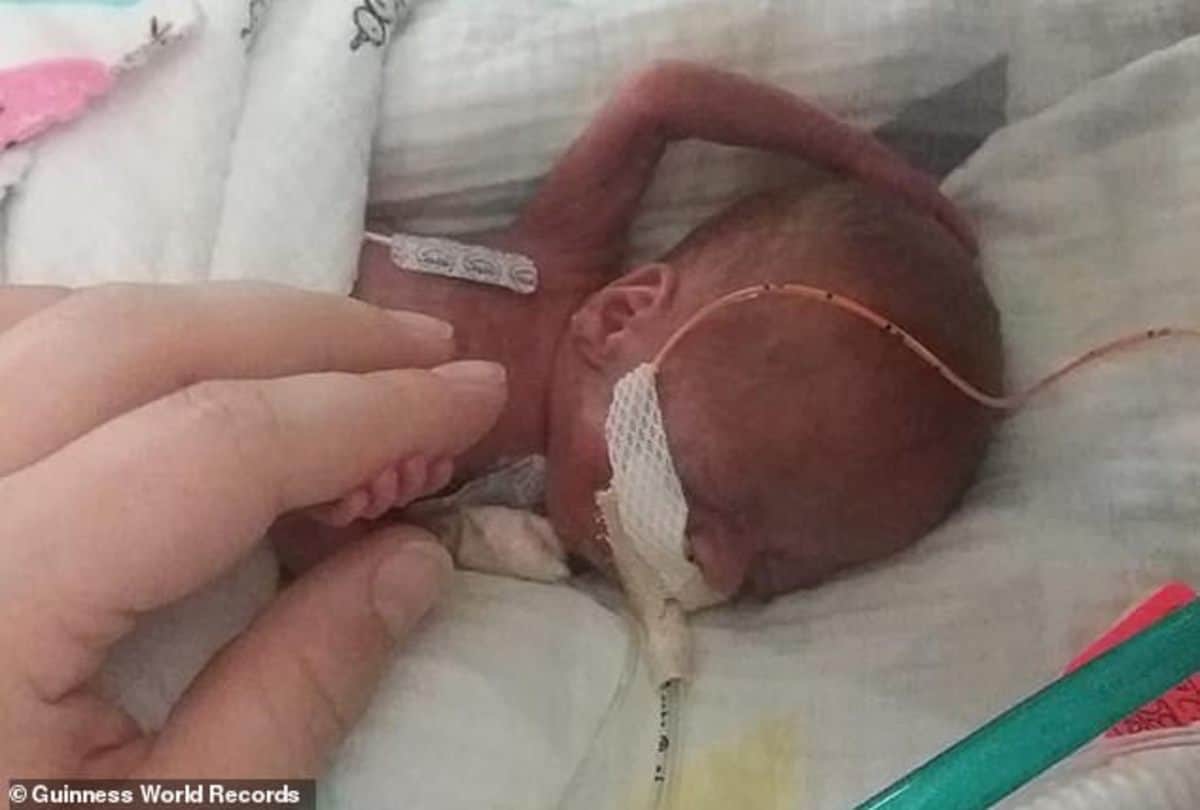 worlds most premature baby fights all odds to celebrate his first birthday
