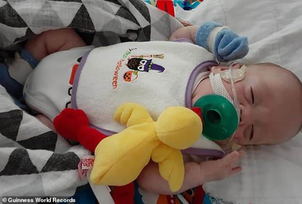 worlds most premature baby fights all odds to celebrate his first birthday