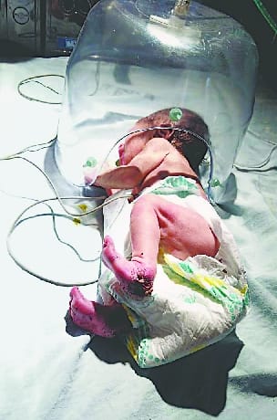 The condition of the unclaimed newborn girl found in the field deteriorated