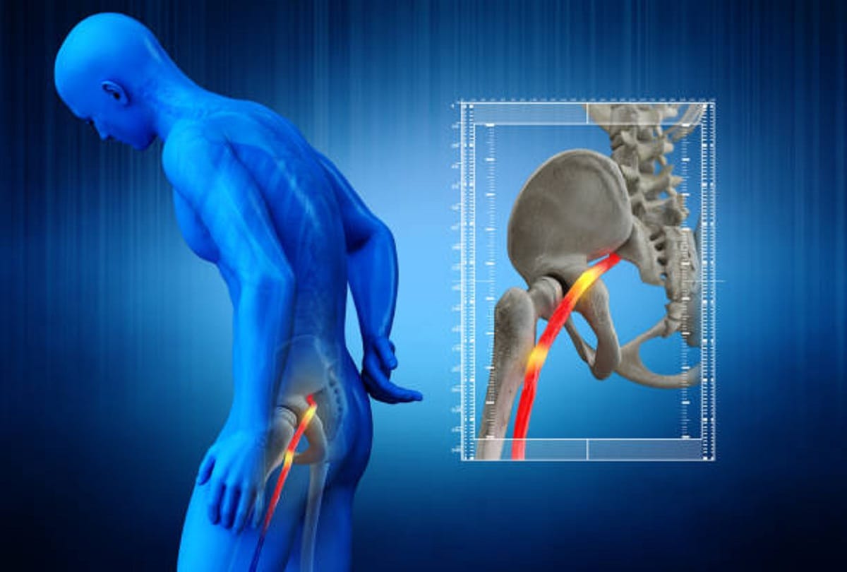 Nerve Pain Sciatica Symptoms Causes and precautions