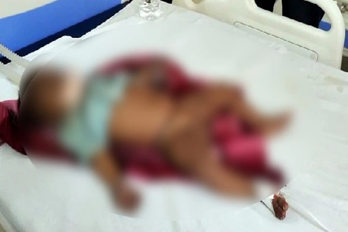 Mother fired with hot bars after five month old girl pneumonia in rajasthan