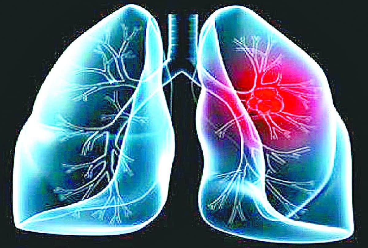 lung cancer symptoms on hand and fingers, know how to prevent lung cancer