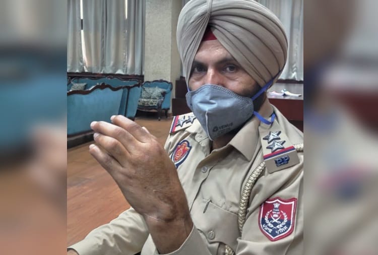 Chandigarh PGI Will soon Start Skin Bank for Burn Patients