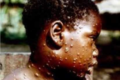 एमपॉक्स संक्रमण के मामले