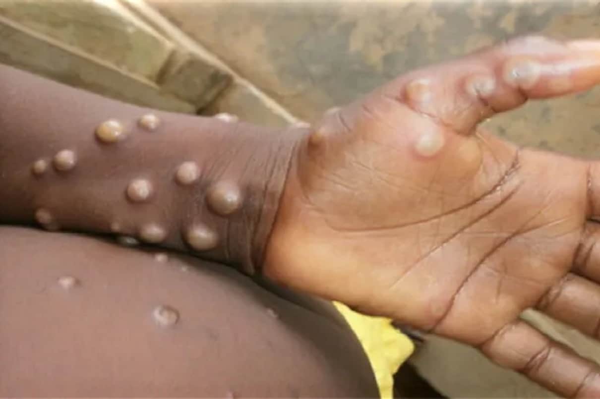 monkeypox alert in india, monkeypox symptoms causes and treatment in hindi