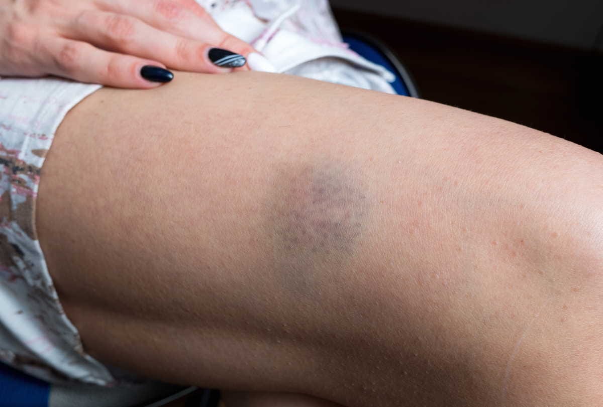 hematoma causes and symptoms, how to get rid of a hematoma