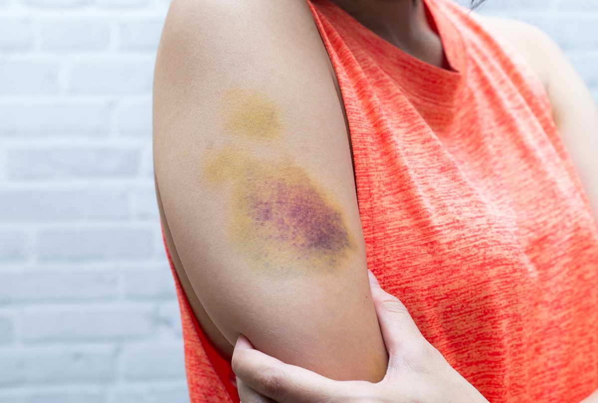 hematoma causes and symptoms, how to get rid of a hematoma