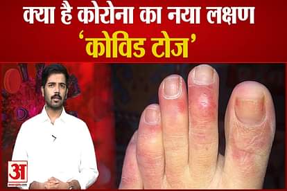 covid toes the new symptom of coronavirus affects hands and legs