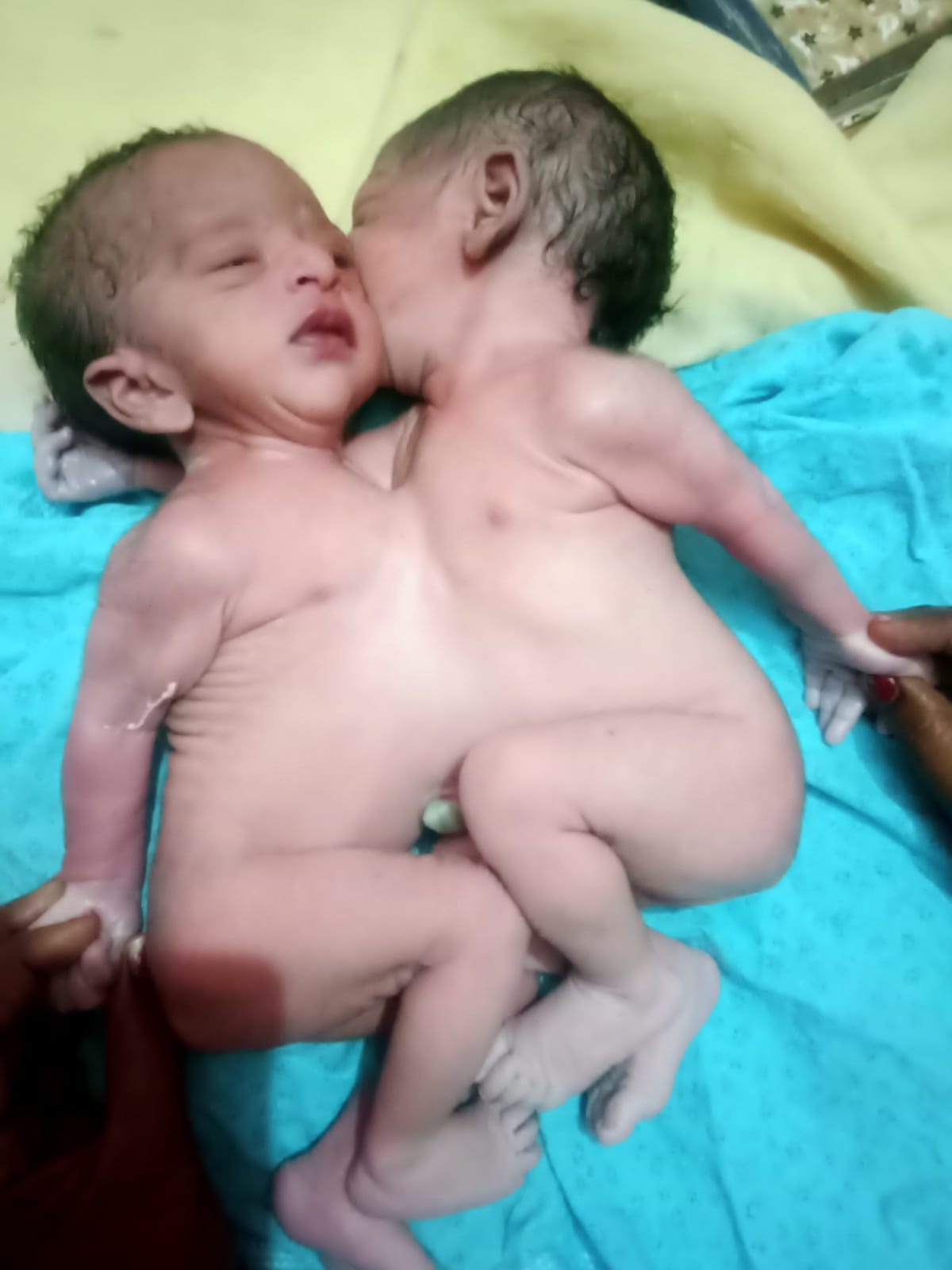 Chest related children born in Tehrauli PHC