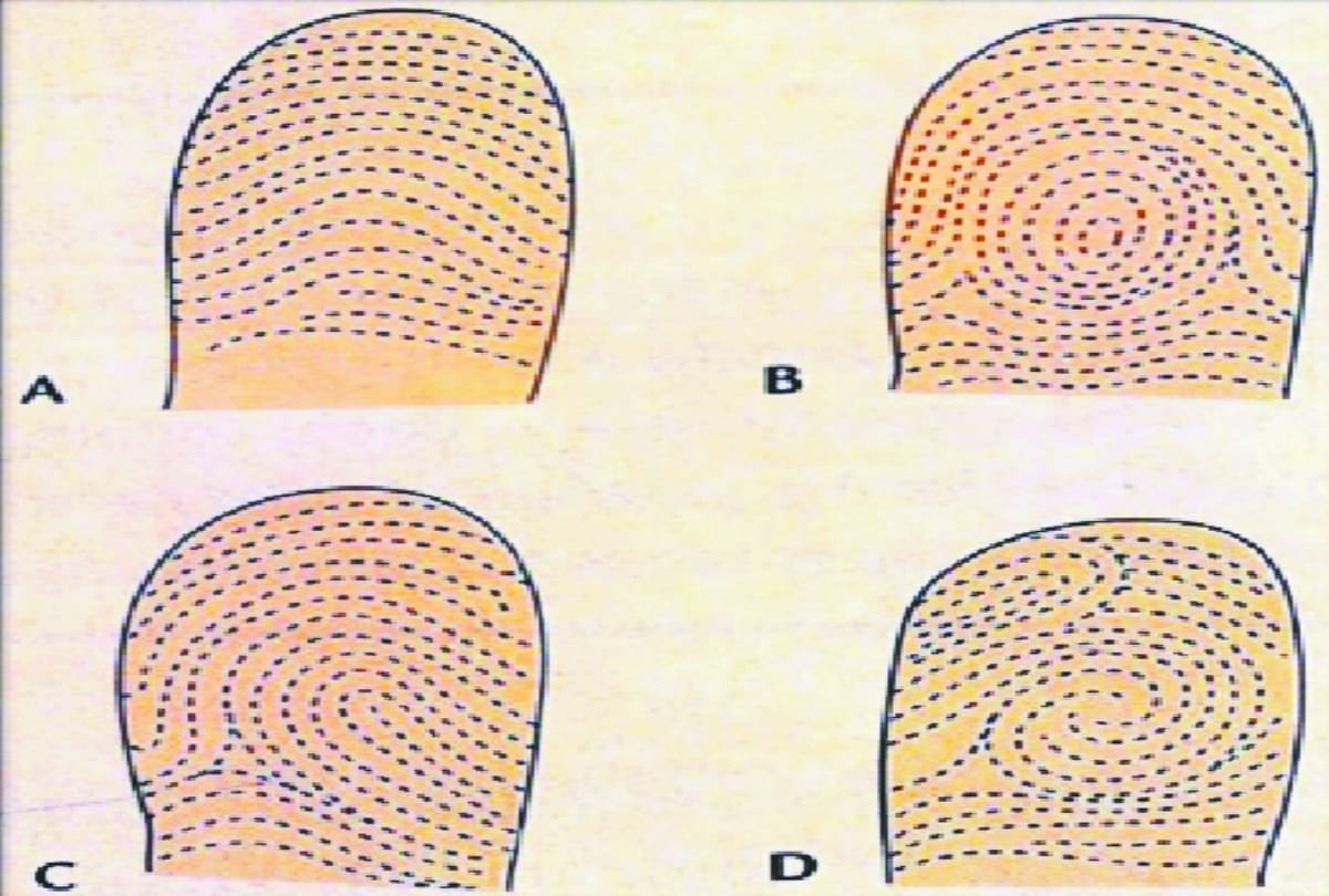 Finger lines will reveal impotence of men know research of Department of Anatomy of BRD Medical College
