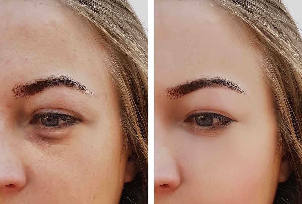 Dark circles are spoiling your beauty so Castor oil can help you