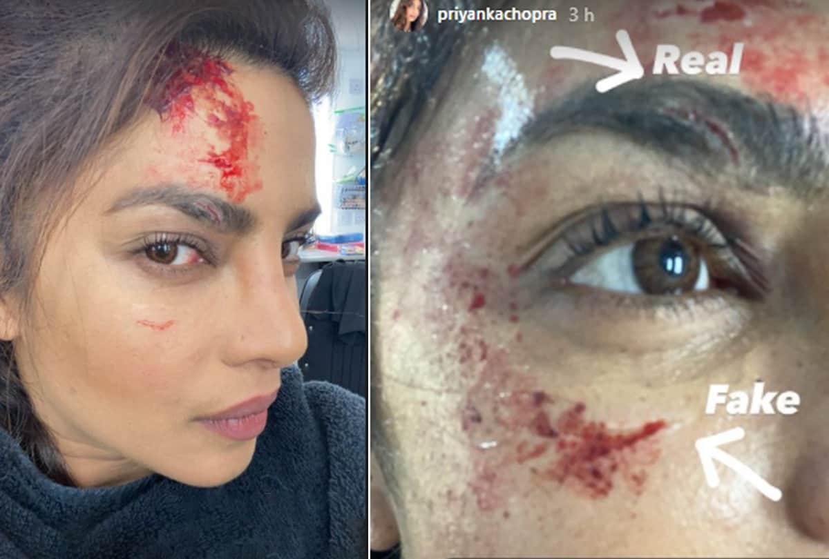 Priyanka Chopra gets hurt on the sets of Citadel, shares pics