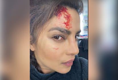 Priyanka Chopra gets hurt on the sets of Citadel, shares pics