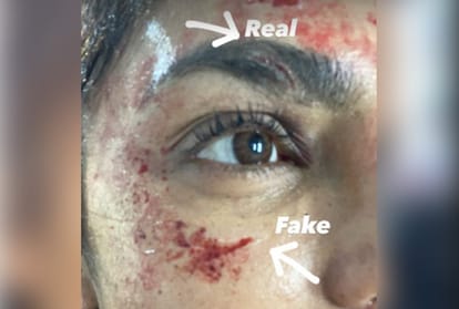 Priyanka Chopra gets hurt on the sets of Citadel, shares pics