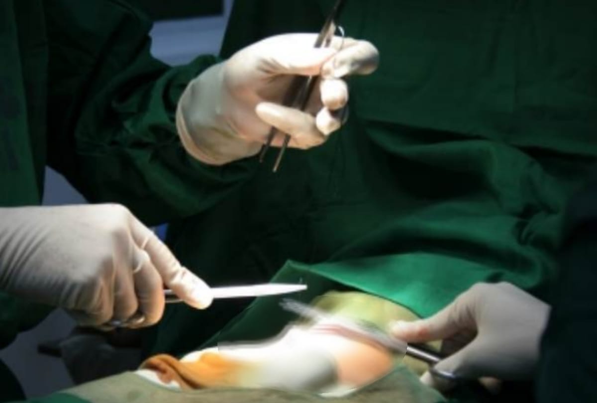 31 KG tumor found in a woman's stomach.