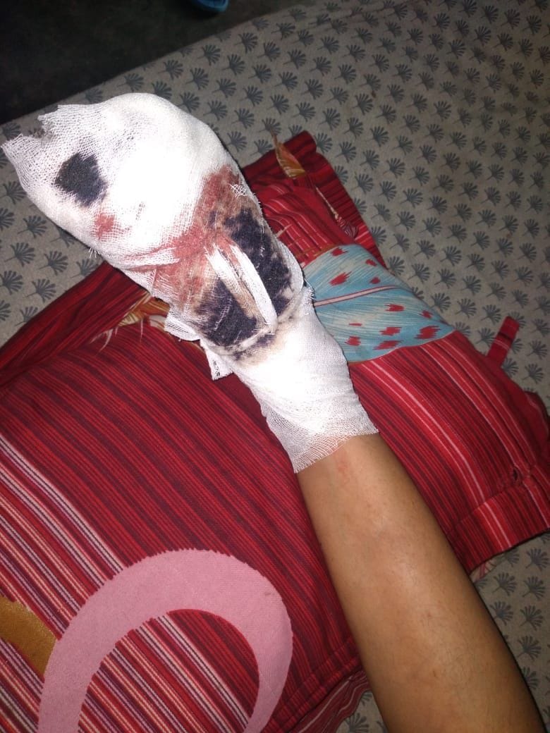 Woman injured by Balam cucumber fell from tree, got 12 stitches on her leg