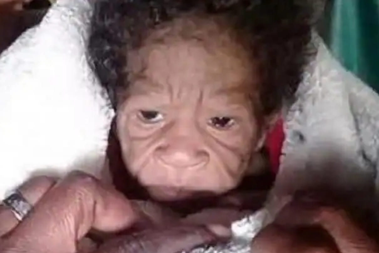 Newborn baby look Like sixty year old due to rare progeria in south africa