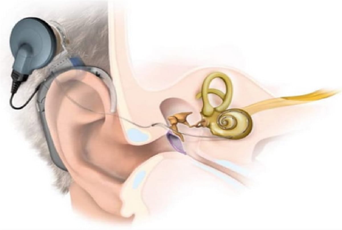 Jammu and Kashmir: no longer have to go for cochlear implants to Delhi and Chandigarh facility will be available here