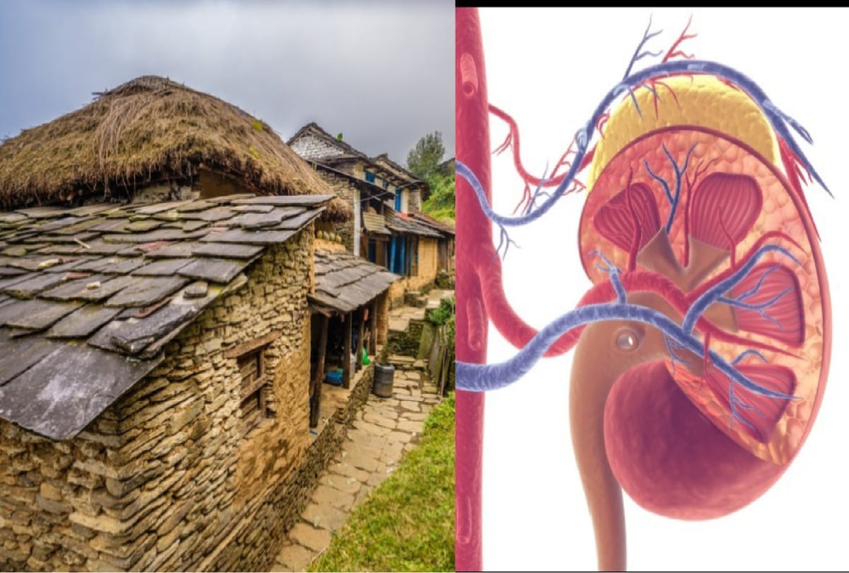 Kidney Valley Interesting story of Unique village of Nepal Where everyone has only one kidney