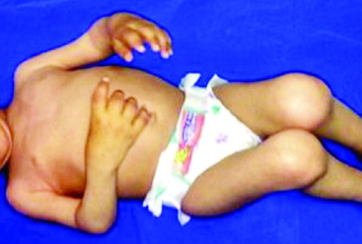 World Arthritis Day 2021: Obesity And Weight Increased Arthritis Patients