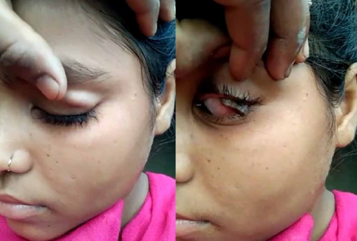 Kannauj: Stones are coming out of the eyes of the teenager people are astonished
