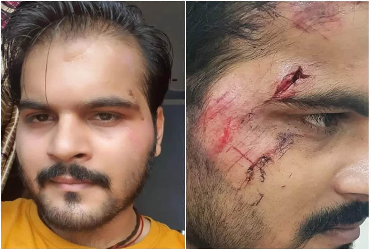 Bhojpuri: Actor Arvind Akela Kallu injured during the shooting of the film shared the photo on social media
