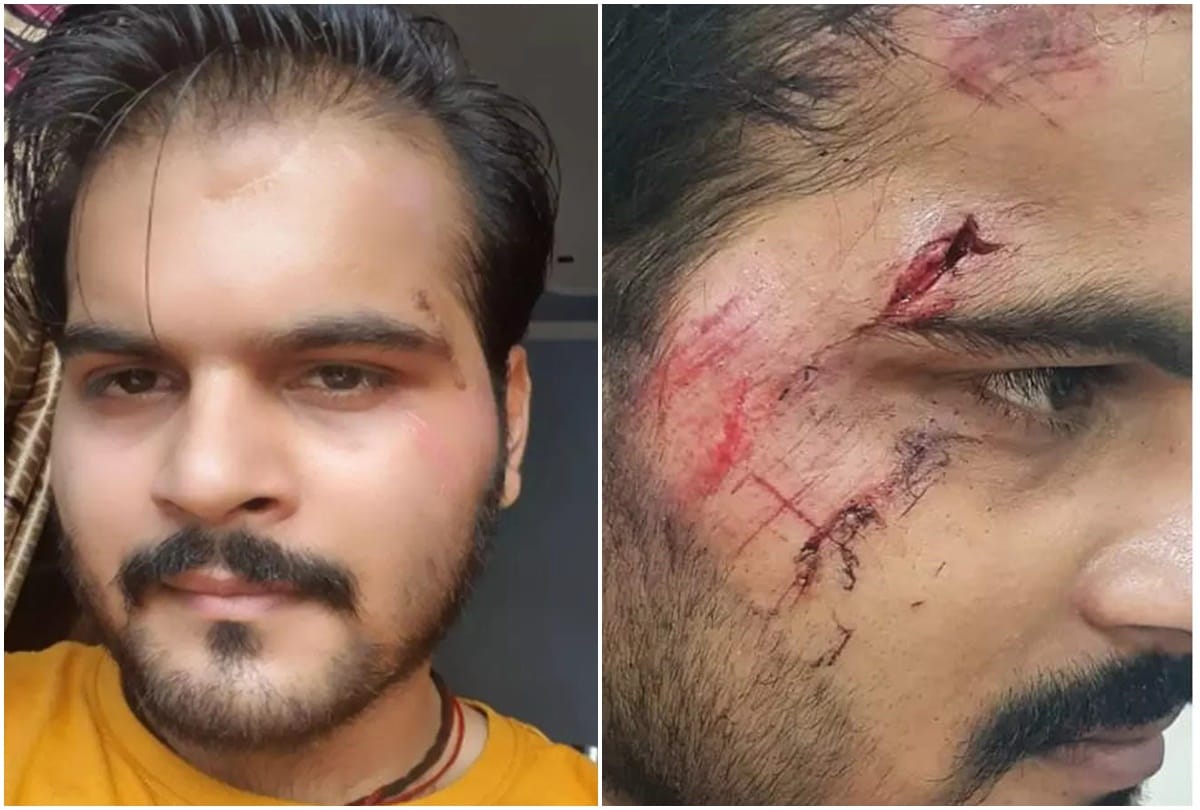 Bhojpuri: Actor Arvind Akela Kallu injured during the shooting of the film shared the photo on social media