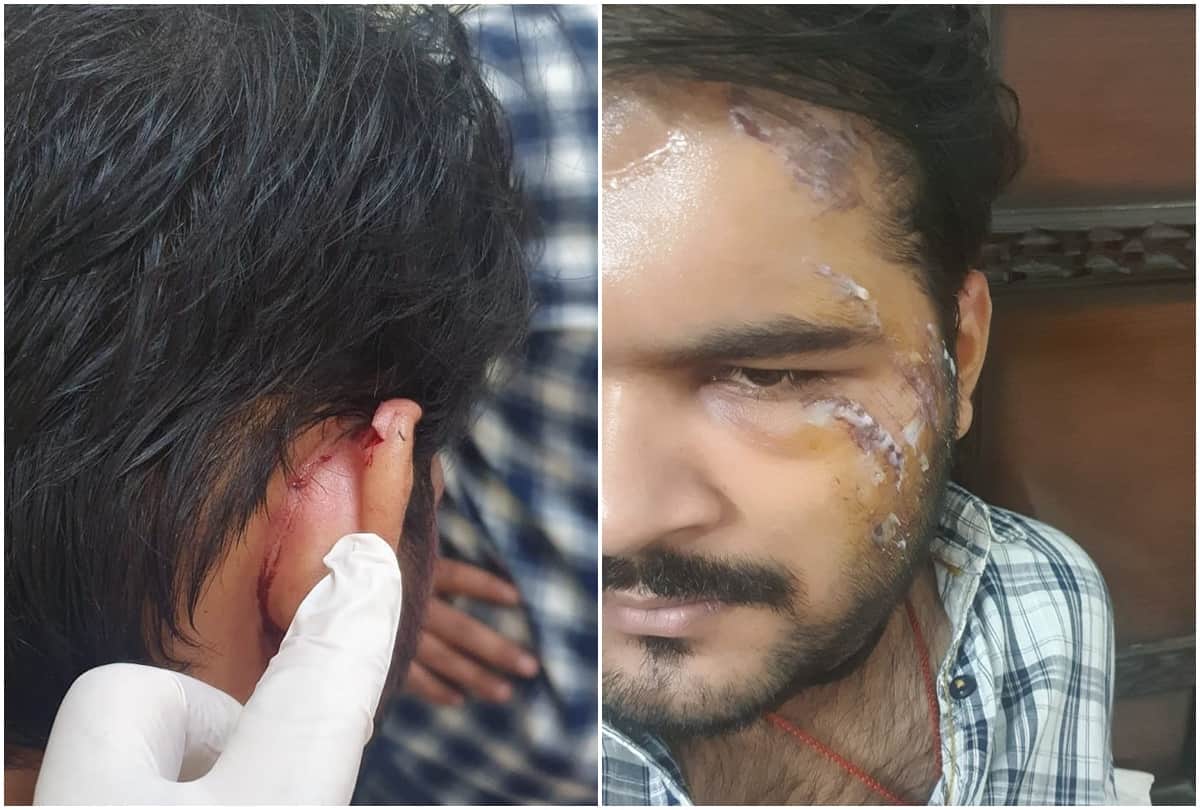 Bhojpuri: Actor Arvind Akela Kallu injured during the shooting of the film shared the photo on social media