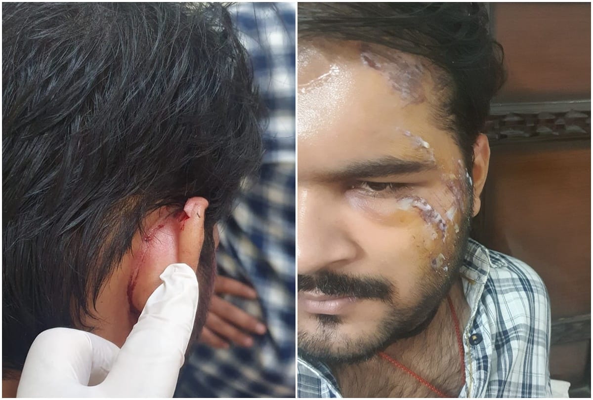 Bhojpuri: Actor Arvind Akela Kallu injured during the shooting of the film shared the photo on social media