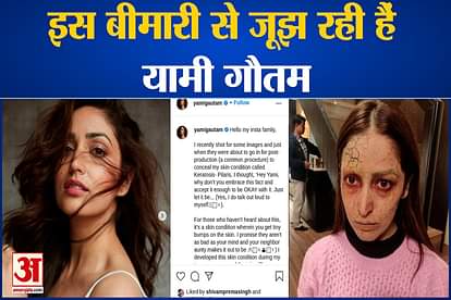 Yami Gautam is Suffering Keratosis Pilaris