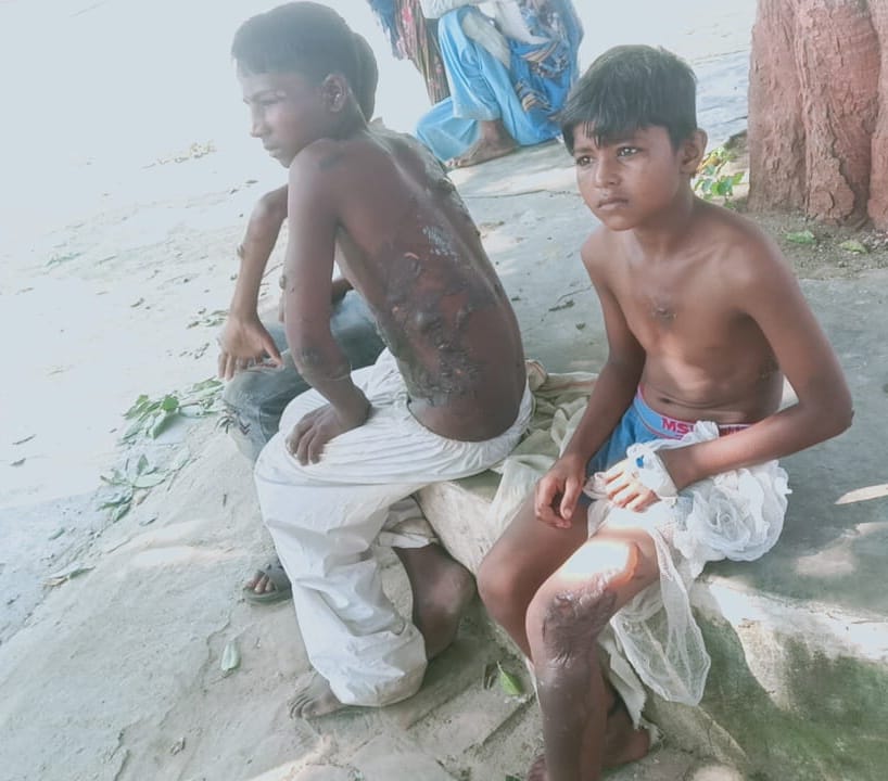 If they did not give free bhatures, then the bullies overturned the pan, three children were scorched by the boiling oil.