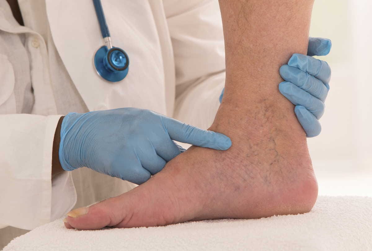 symptoms of severe fatty liver disease