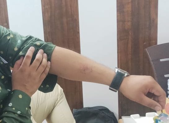 Meter uprooted in electricity theft, two workers cut with teeth