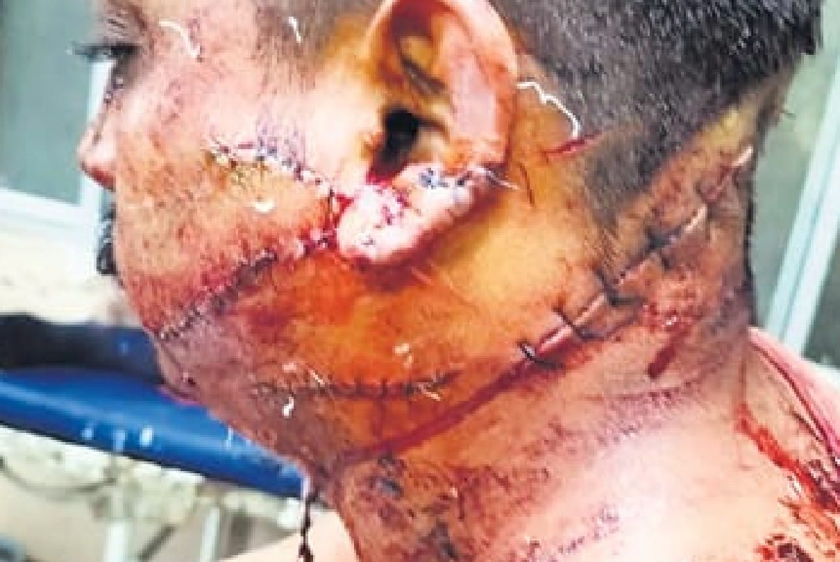 Indore: After one year of love marriage, brother-in-law had so many blows that 60 stitches had to be done