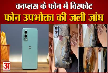 Oneplus phone explodes phone user burnt thigh reaches hospital