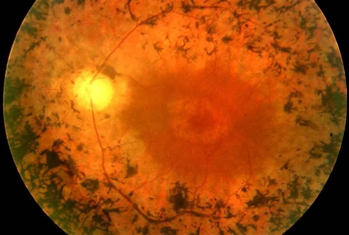 Kanpur: For the first time in the country, stem cells will be used in eye treatment