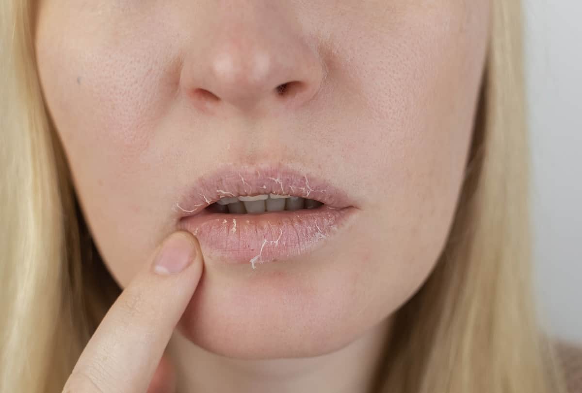 Winter Tips for Chapped Lips, Dry Skin And Crack Heel Treatment Home Remdies In Hindi