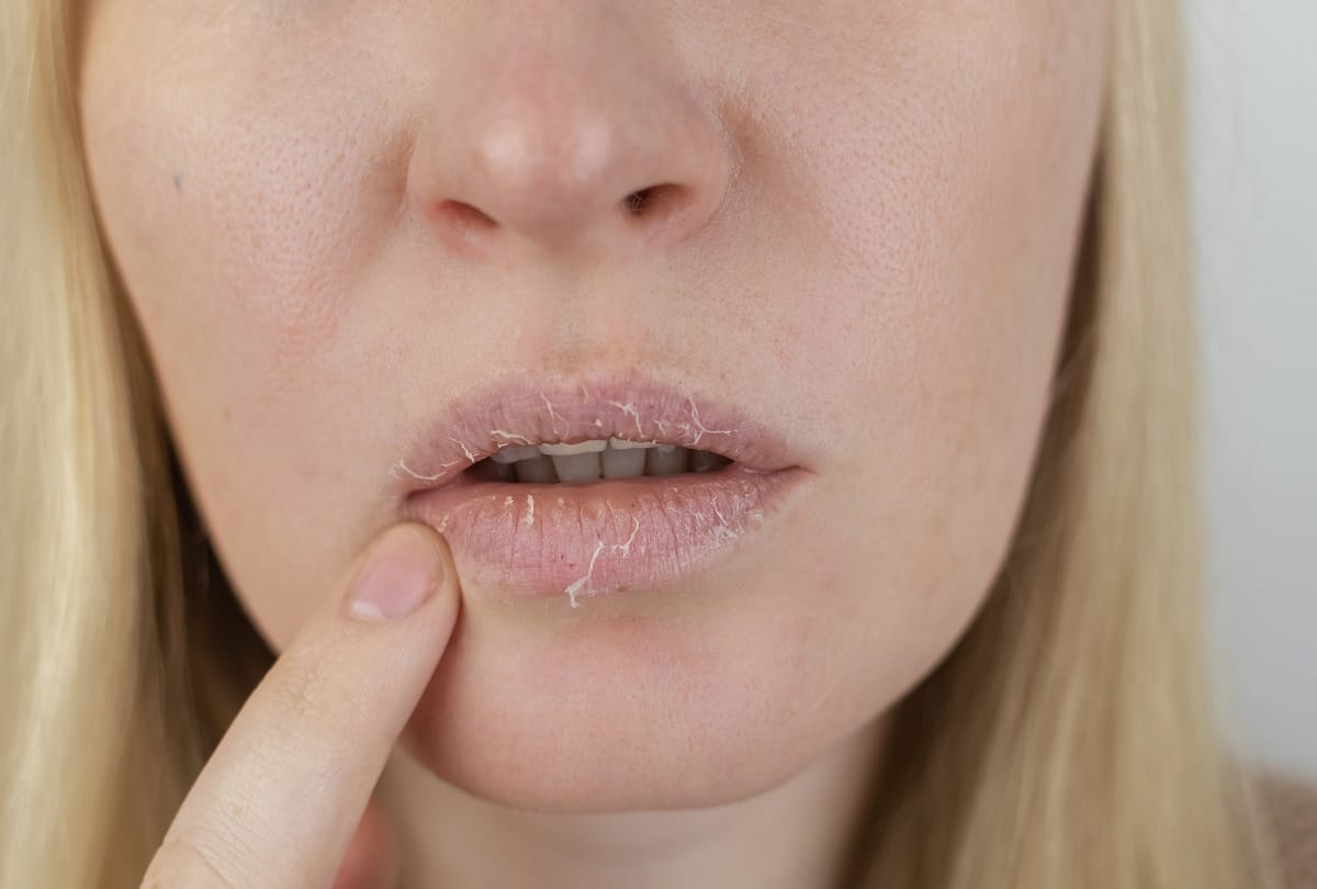 five ways to get rid of chapped lips