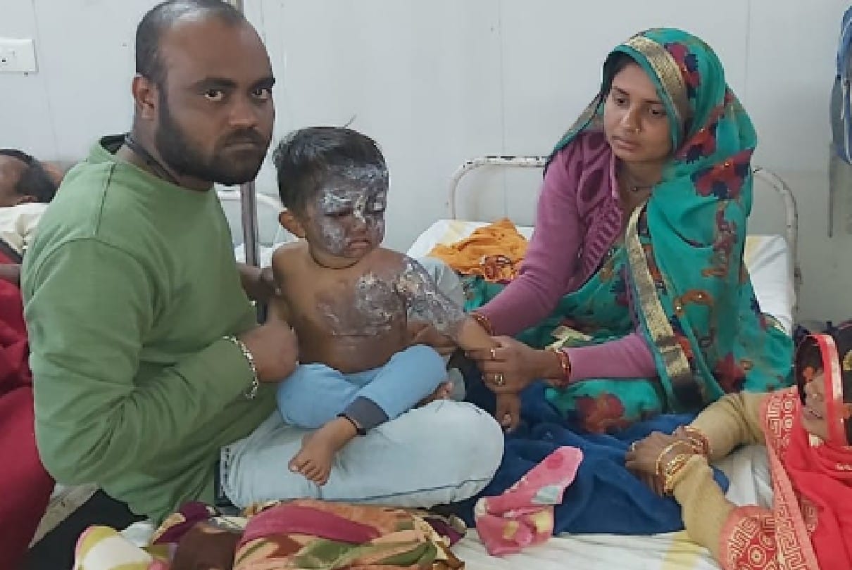Chhatarpur: Two year old child pours boiling water on himself in Badamalhara, admitted to district hospital in critical condition