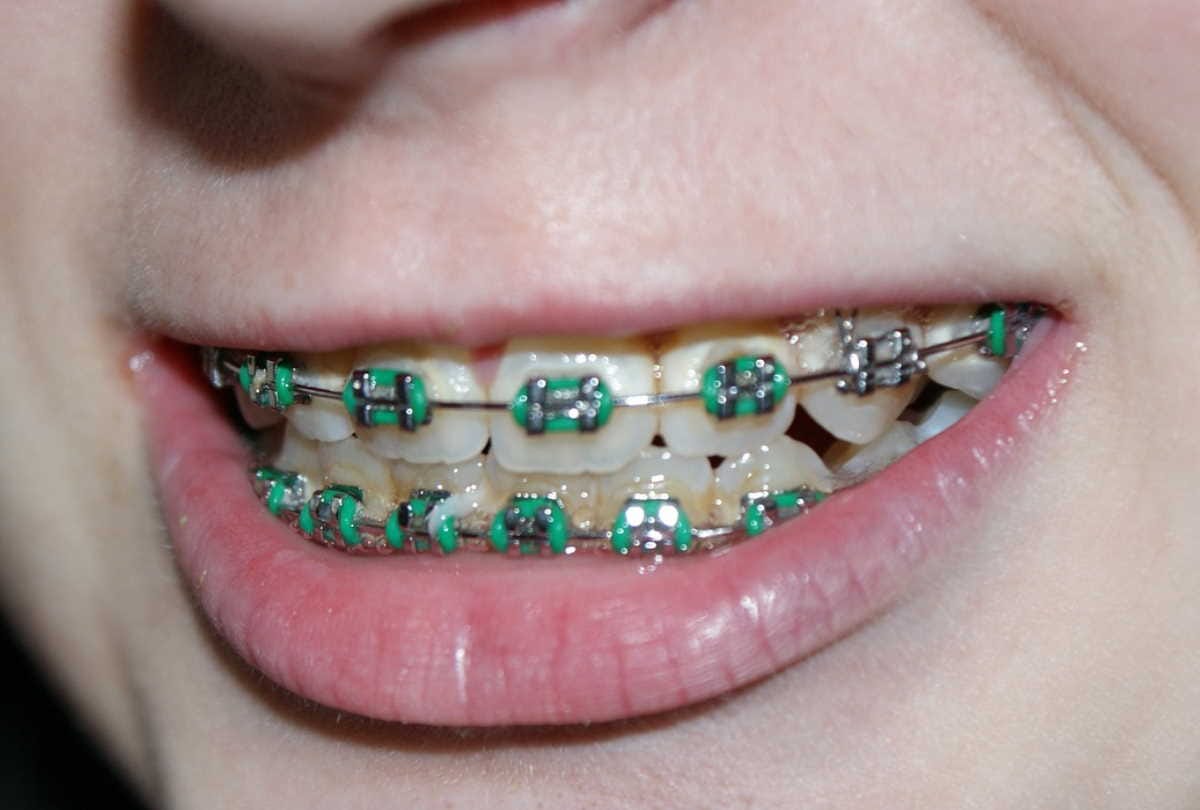 Dental care tip, how to prevent braces teeth infection