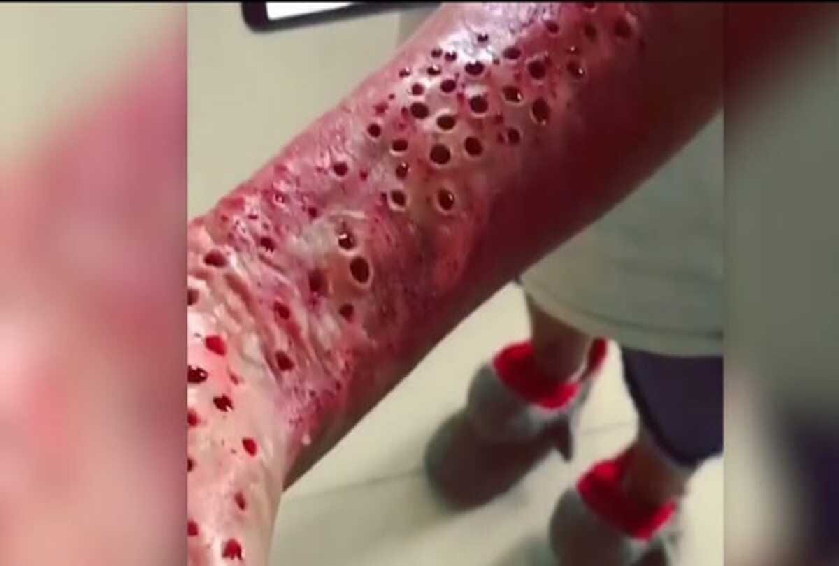 know reality of holes in hand photo goes viral on social media