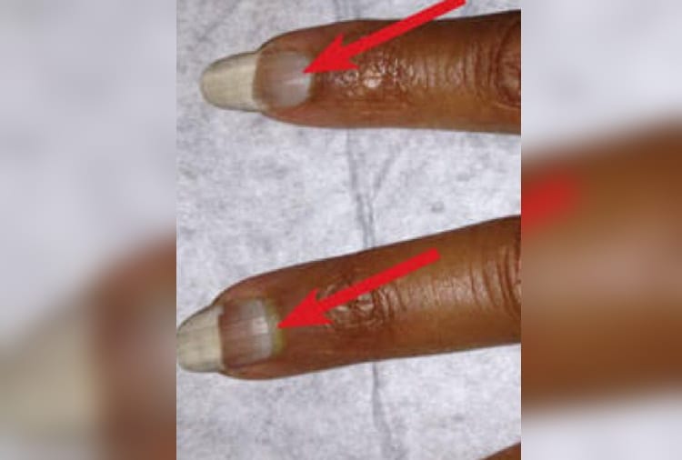 Change in color of lips and nails can be a sign of Omicron