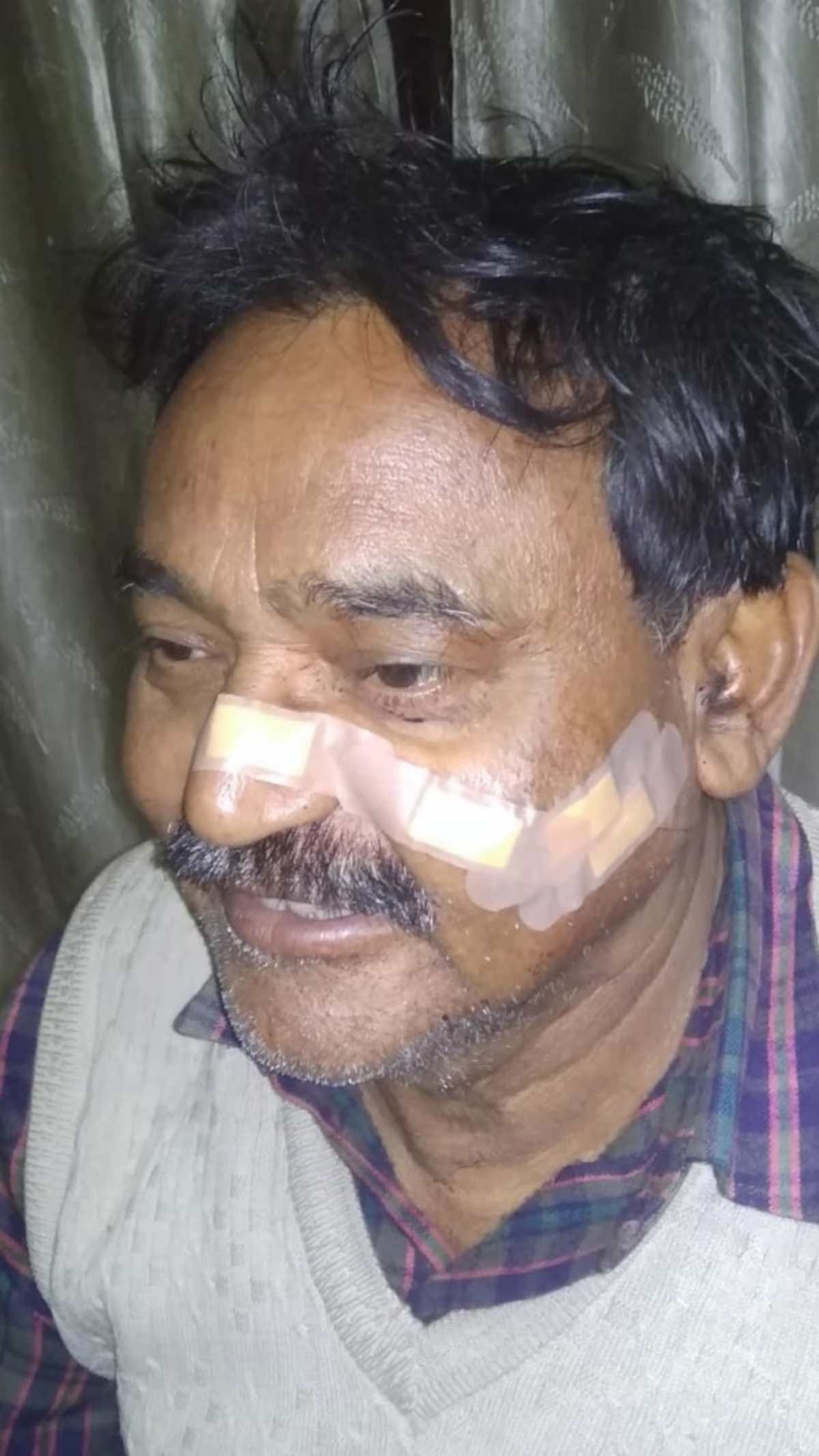 Chinese manjha snatched another life man died cut throat and nose had stitches in BHU trauma center Varanasi